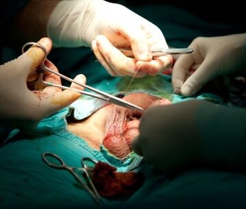 cirurgia para aumentar o pênis