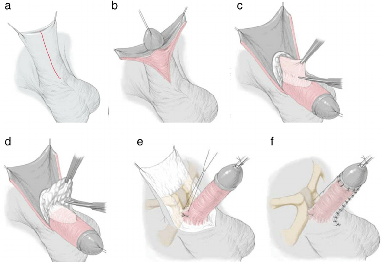 ligamentotomia para aumento do pênis